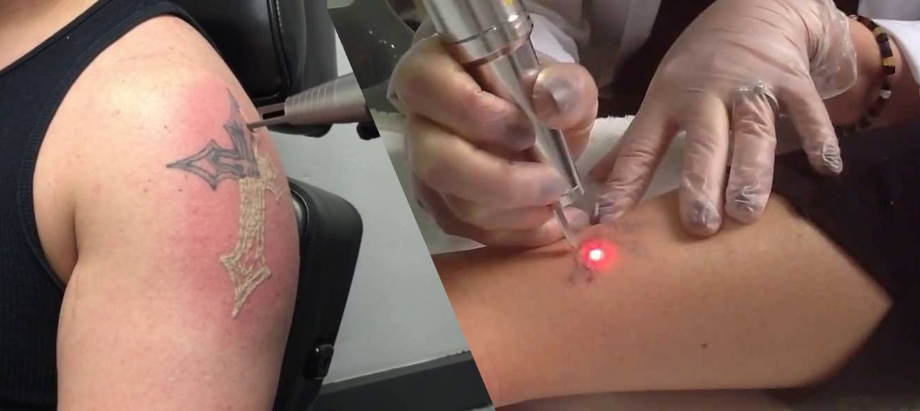 How to Identify Good Laser Tattoo Removal Facility